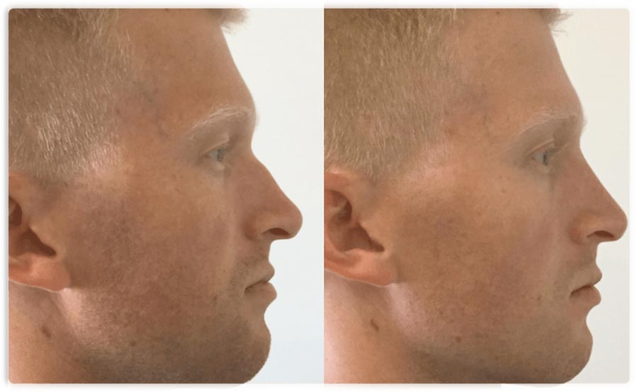 Non Surgical Nose Job
