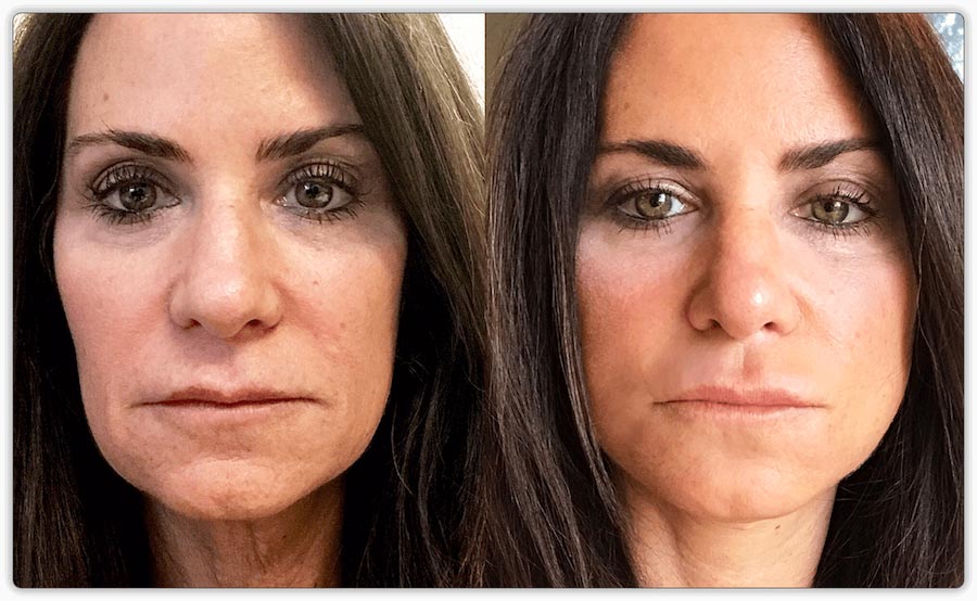 PRP Treatments