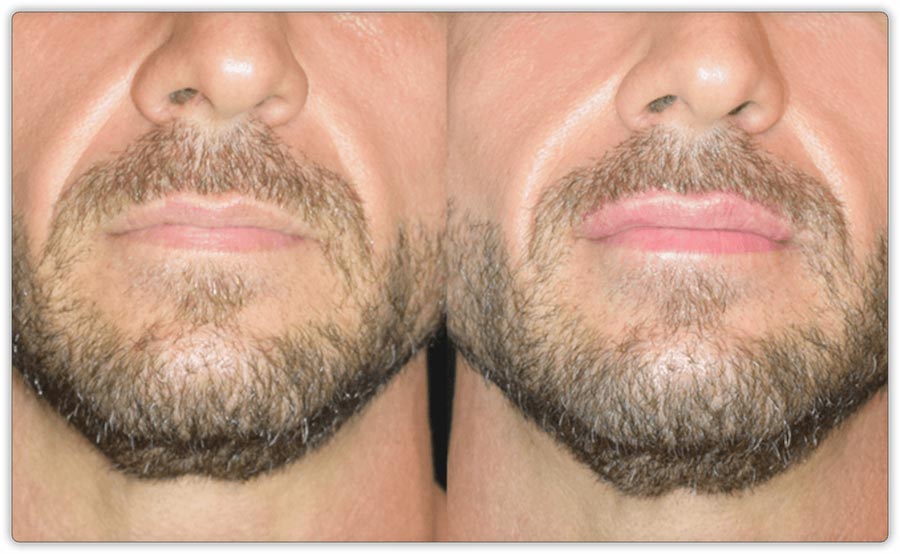 Lip Fillers
