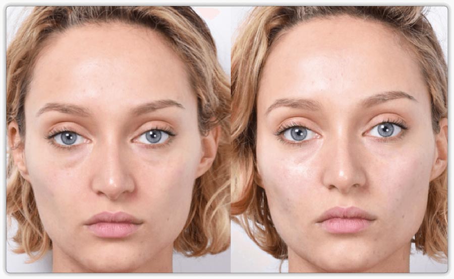 Before and after Facelift, PRP Treatments
