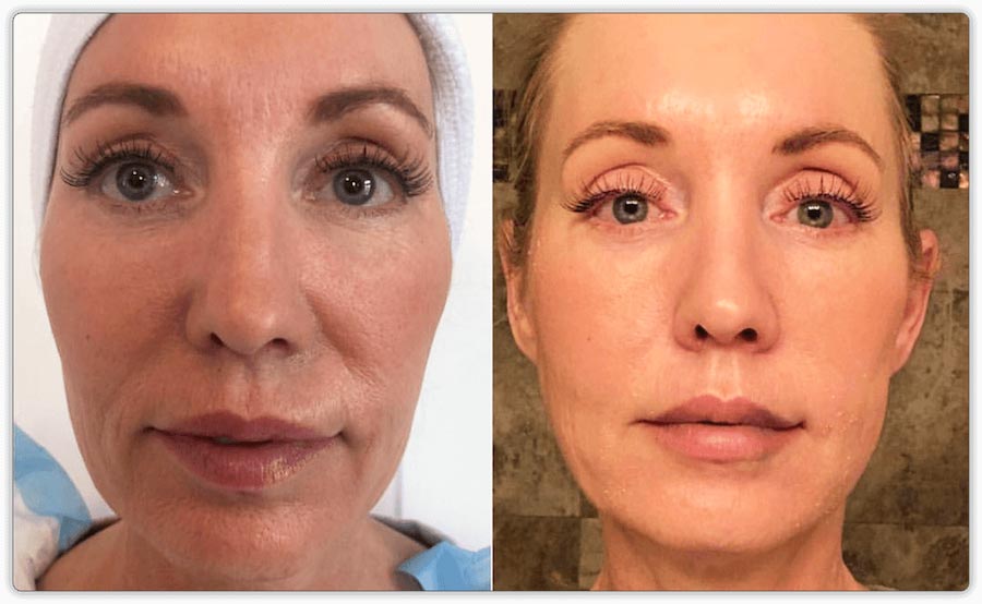 Before and after PRP Treatments