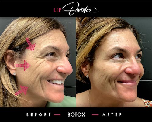 Expert Botox® Treatments