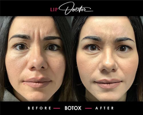 Expert Botox® Treatments