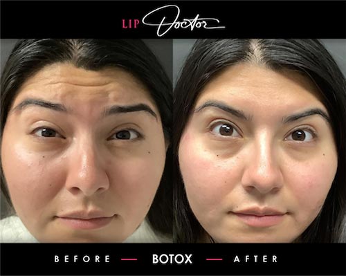 Expert Botox® Treatments