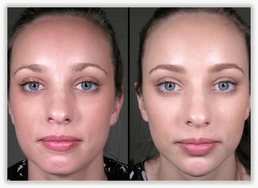 Non-Surgical Facelift