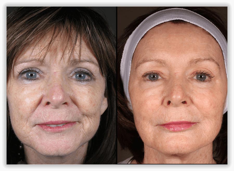 Non-Surgical Facelift