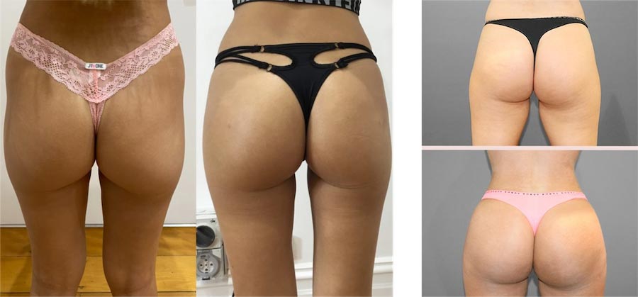 Cellulite