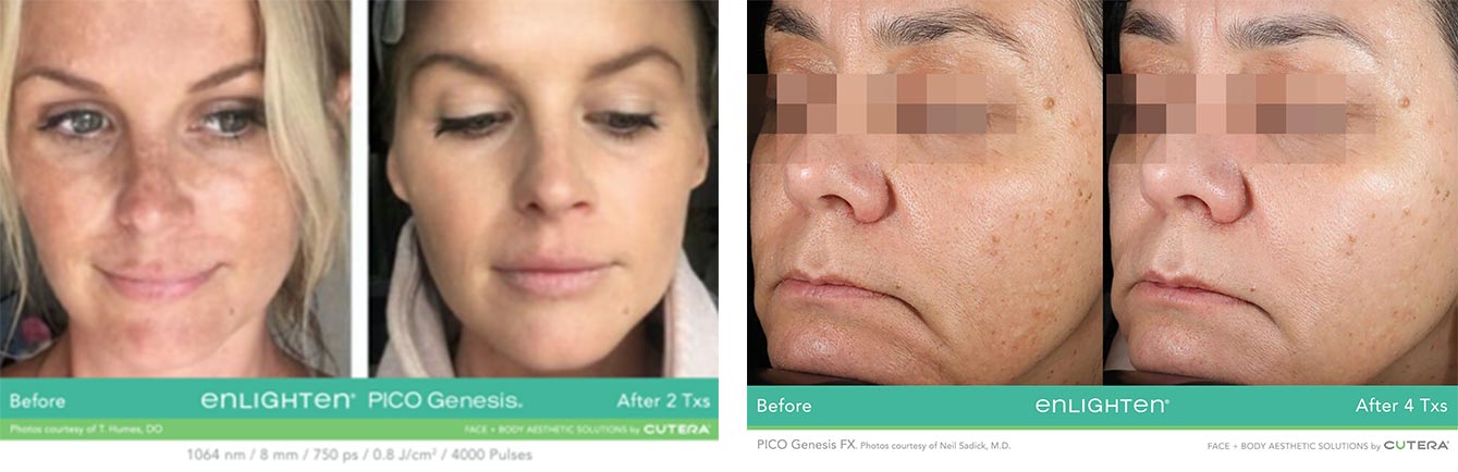 Before and after Treatment