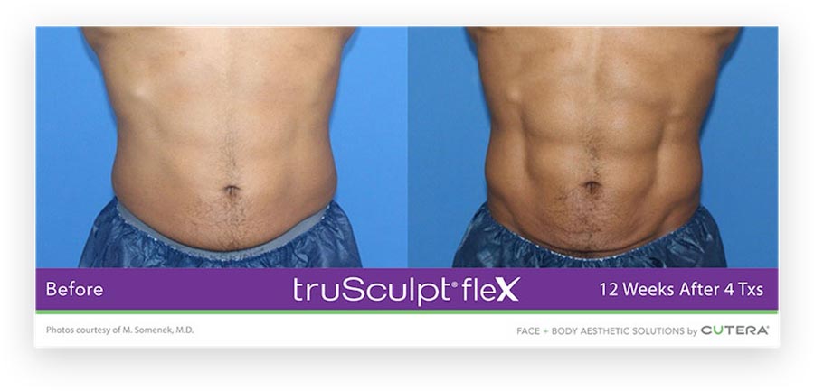 truSculpt® flex