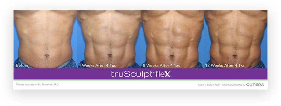 truSculpt® flex Treatments