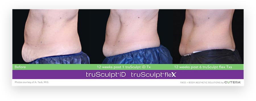 truSculpt® flex