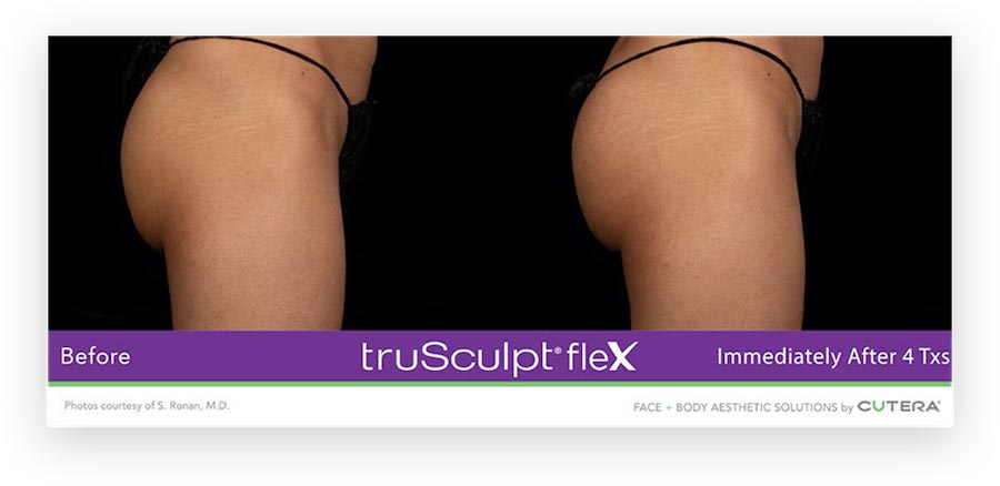 Before and after truSculpt® flex