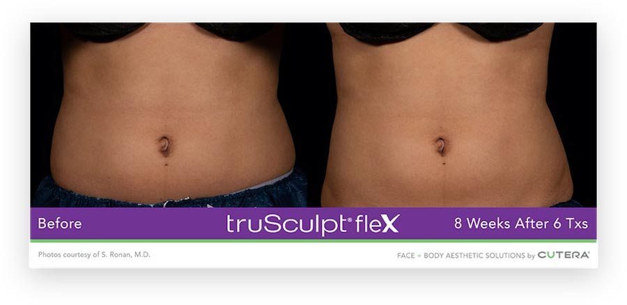 truSculpt® flex