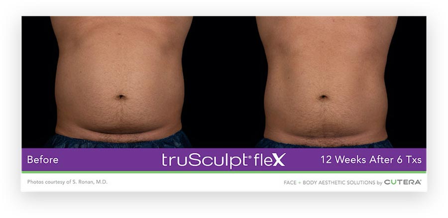 truSculpt® flex