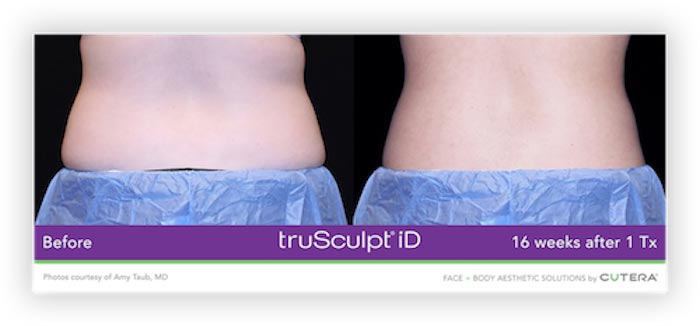 truSculpt® iD