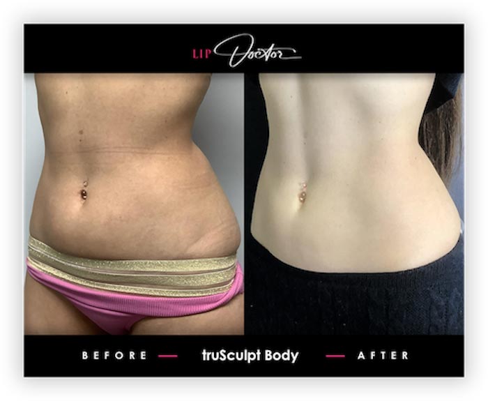 truSculpt® iD