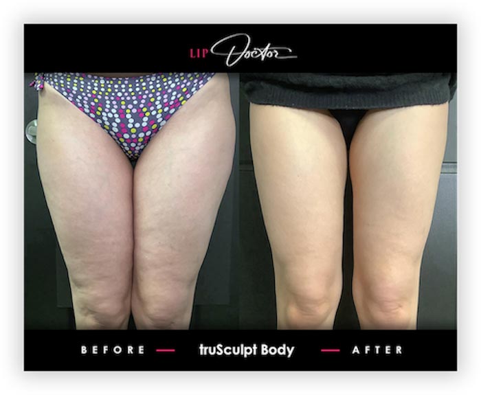 Before and After Treatment of truSculpt® iD