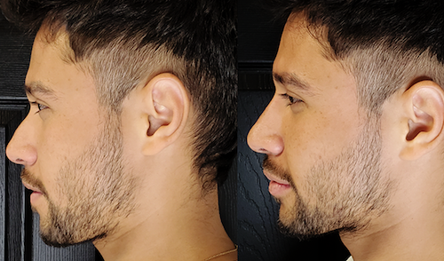 Non-Surgical-Nose-job-Before-After-Mississauga-Oakville
