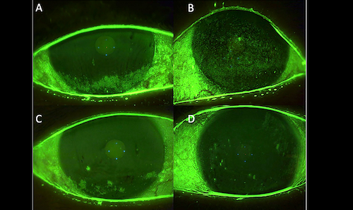 dry-eye-treatment-before-after-mississauga-oakville