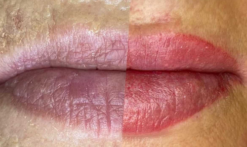 lip-shading-discoloration-correction-lip-doctor-mississauga-oakville-toronto